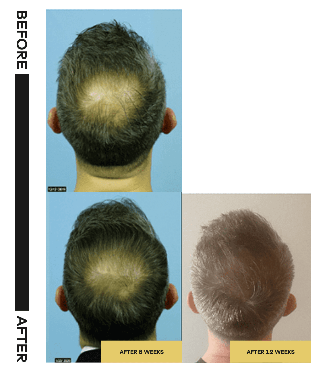 Hair Restoration